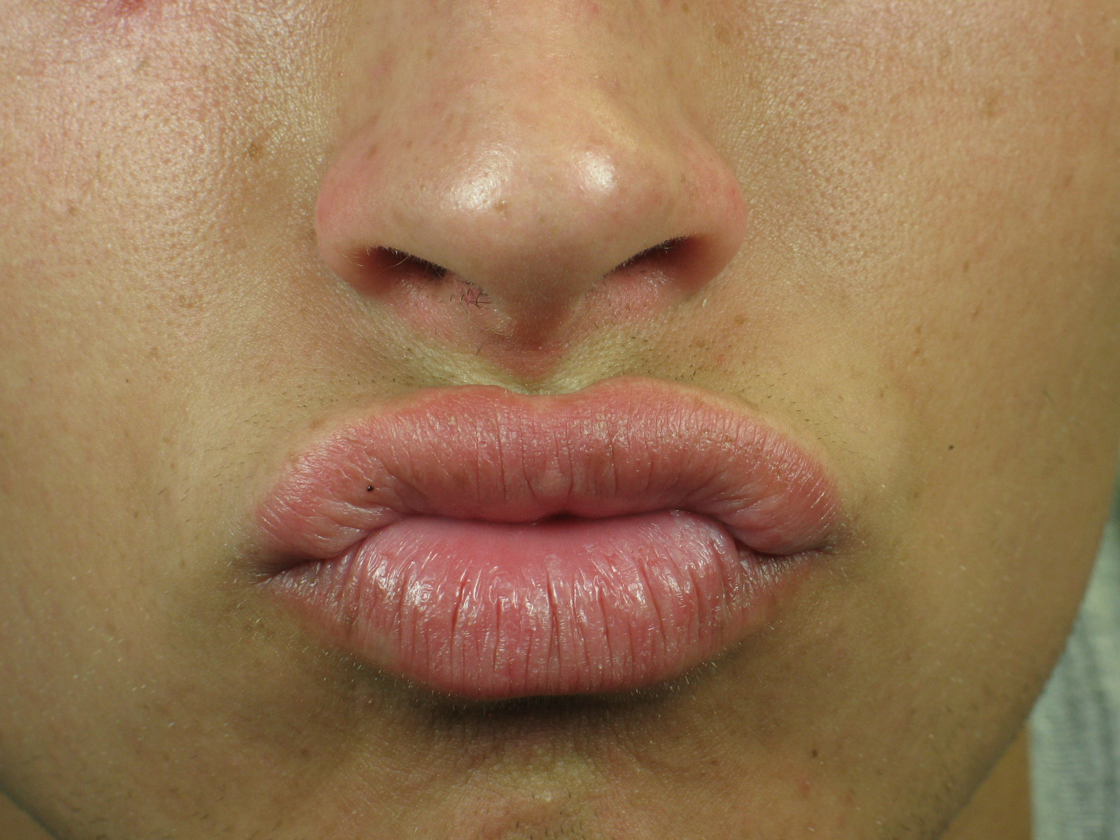 wart on lip after laser treatment wart on lip after laser treatment